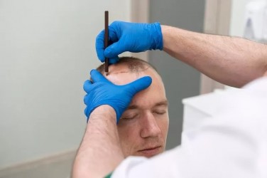 mengenal-proses-transplantasi-rambut-solusi-untuk-atasi-kebotakan